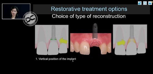 Choice of type of reconstruction in esthetic and non-esthetic areas 